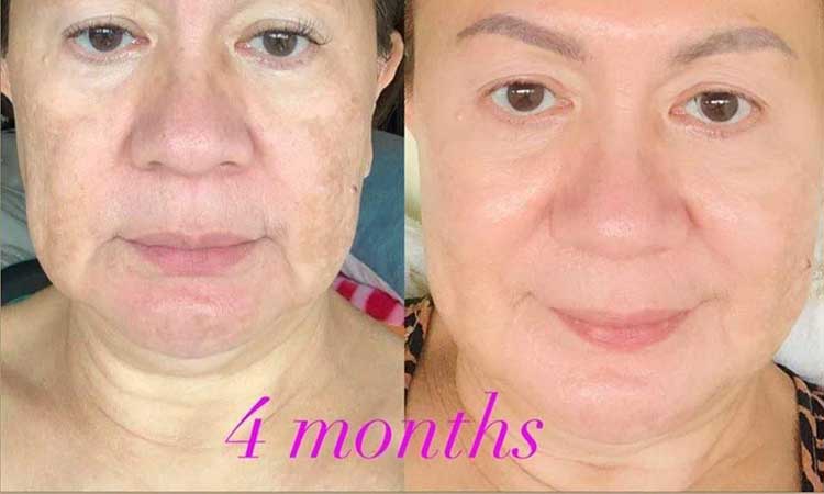 LifeWave before & after