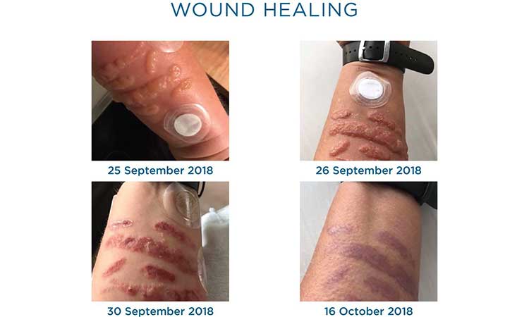 Wound Healing